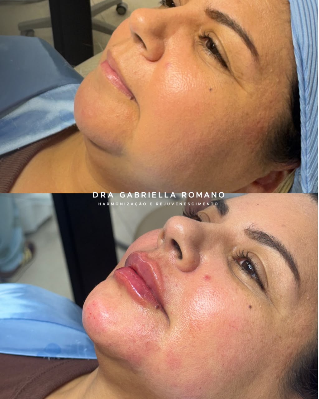 Comparativo de harmonização facial full face